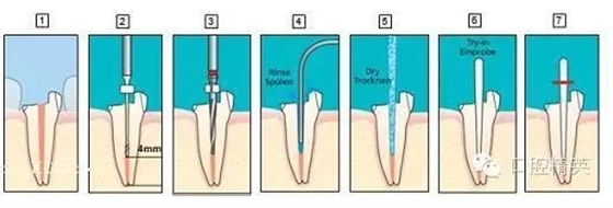 后牙烤瓷橋備牙全過程 后牙烤瓷橋備牙全過程