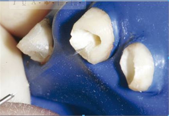 后牙烤瓷橋備牙全過程 后牙烤瓷橋備牙全過程