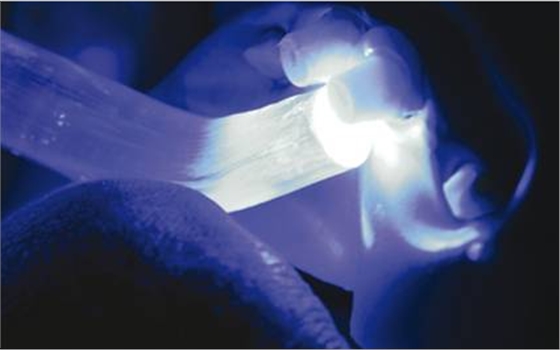 后牙烤瓷橋備牙全過程 后牙烤瓷橋備牙全過程