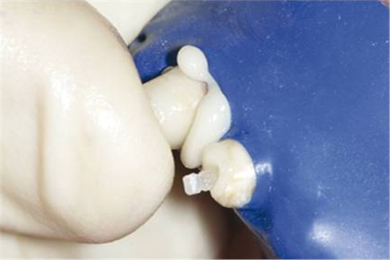后牙烤瓷橋備牙全過程 后牙烤瓷橋備牙全過程