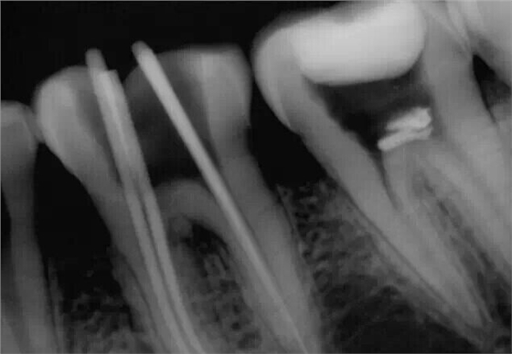 牙醫(yī)的&ldquo;癢癢&rdquo;&mdash;&mdash; 斷針