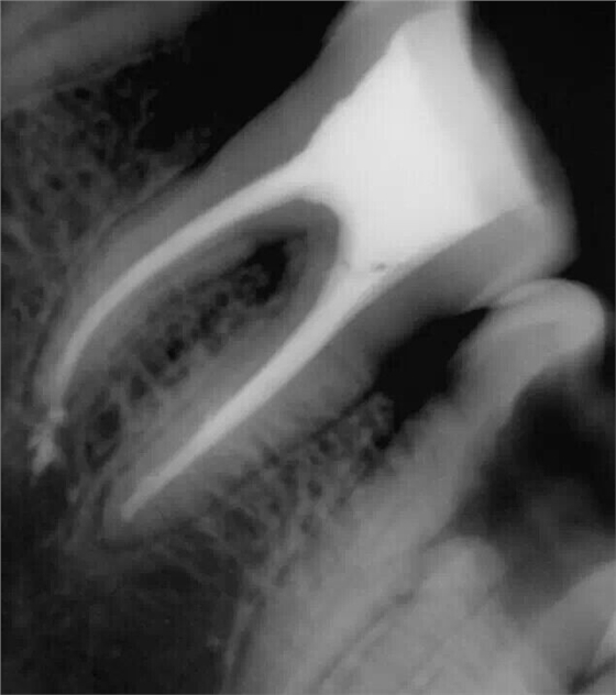 牙醫(yī)的&ldquo;癢癢&rdquo;&mdash;&mdash; 斷針