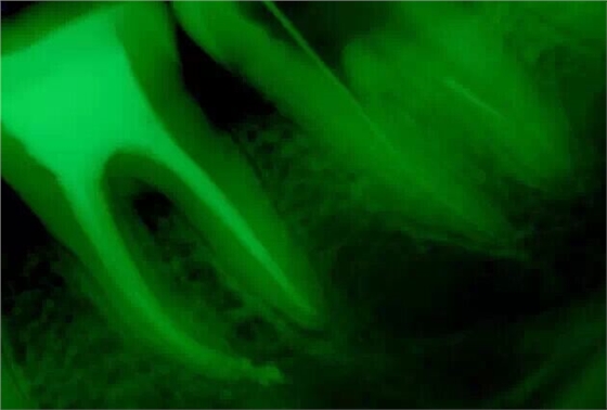 牙醫(yī)的&ldquo;癢癢&rdquo;&mdash;&mdash; 斷針