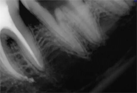 牙醫(yī)的&ldquo;癢癢&rdquo;&mdash;&mdash; 斷針