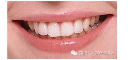 &ldquo;蝴蝶效應&rdquo;：牙齒不齊引起的連鎖反應