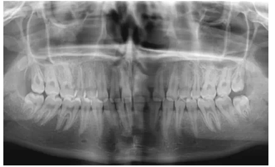 瓷貼面實(shí)戰(zhàn)流程
