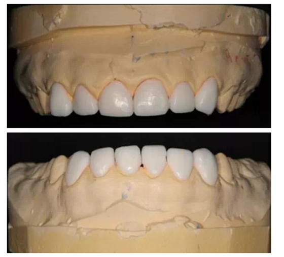 瓷貼面實(shí)戰(zhàn)流程