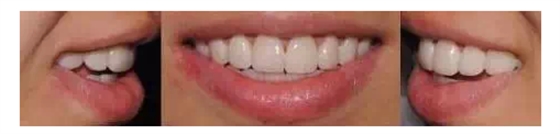 瓷貼面實(shí)戰(zhàn)流程