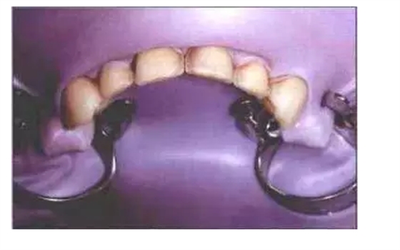 瓷貼面實(shí)戰(zhàn)流程