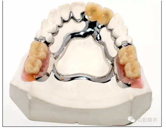 如何選擇活動(dòng)義齒支架的合金 如何選擇活動(dòng)義齒支架的合金