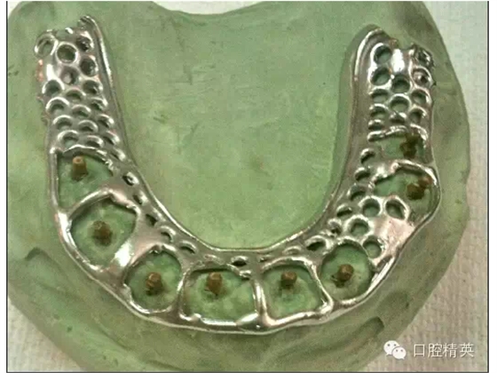 如何選擇活動(dòng)義齒支架的合金 如何選擇活動(dòng)義齒支架的合金
