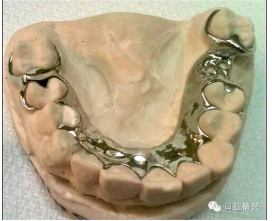 如何選擇活動(dòng)義齒支架的合金 如何選擇活動(dòng)義齒支架的合金