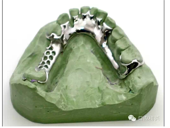 如何選擇活動(dòng)義齒支架的合金 如何選擇活動(dòng)義齒支架的合金