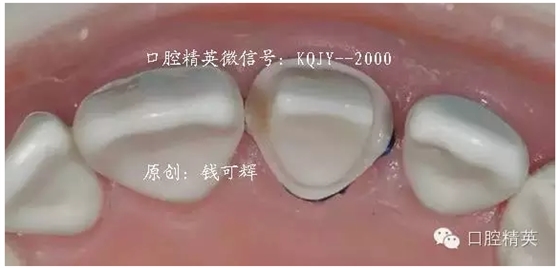 為什么你的牙齒備不好 為什么你的牙齒備不好