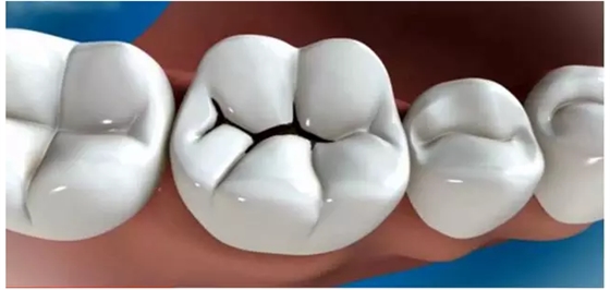 補牙全過程 補牙全過程