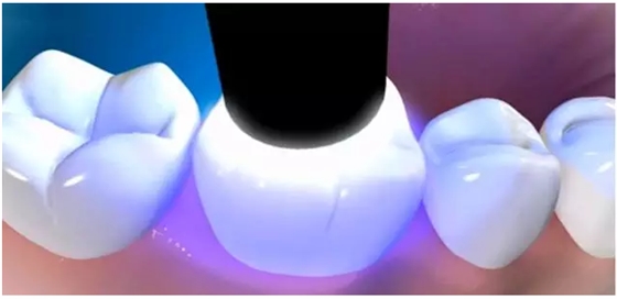 補牙全過程 補牙全過程