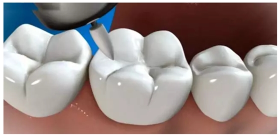 補牙全過程 補牙全過程