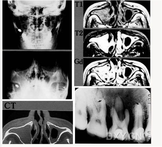 良性成牙骨質(zhì)細(xì)胞瘤