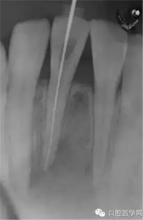 常規(guī)根管治療成功處理根尖周病變較大牙齒 常規(guī)根管治療成功處理根尖周病變較大牙齒