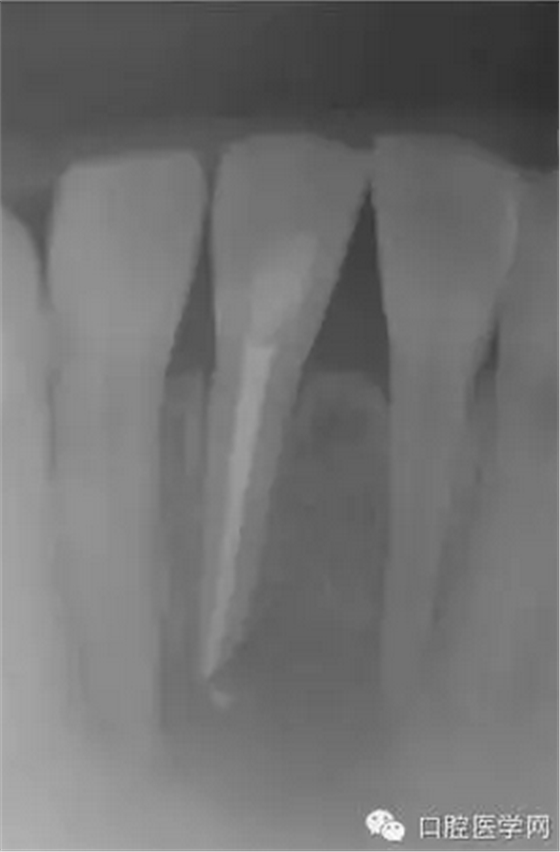 常規(guī)根管治療成功處理根尖周病變較大牙齒 常規(guī)根管治療成功處理根尖周病變較大牙齒