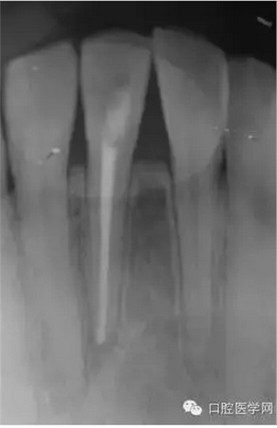 常規(guī)根管治療成功處理根尖周病變較大牙齒 常規(guī)根管治療成功處理根尖周病變較大牙齒