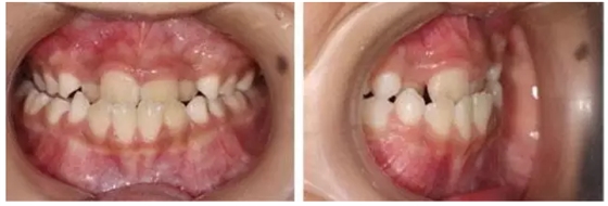 &ldquo;地包天&rdquo;的最佳治療時間