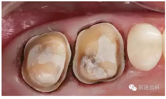 烤瓷牙邊緣不密與咬合高的原因分析 烤瓷牙邊緣不密與咬合高的原因分析