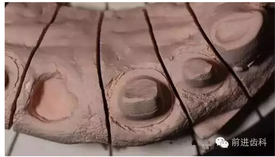 烤瓷牙邊緣不密與咬合高的原因分析 烤瓷牙邊緣不密與咬合高的原因分析