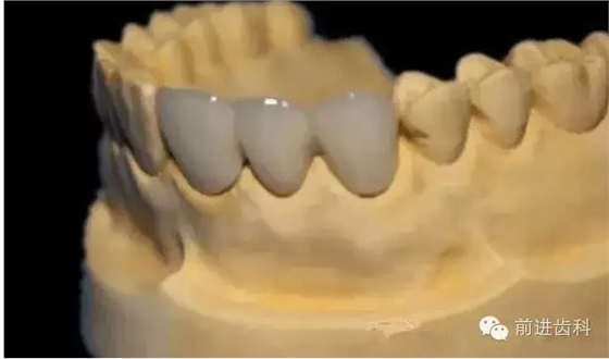 烤瓷牙邊緣不密與咬合高的原因分析 烤瓷牙邊緣不密與咬合高的原因分析
