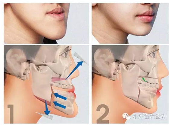 &ldquo;地包天&rdquo;的最佳治療時間