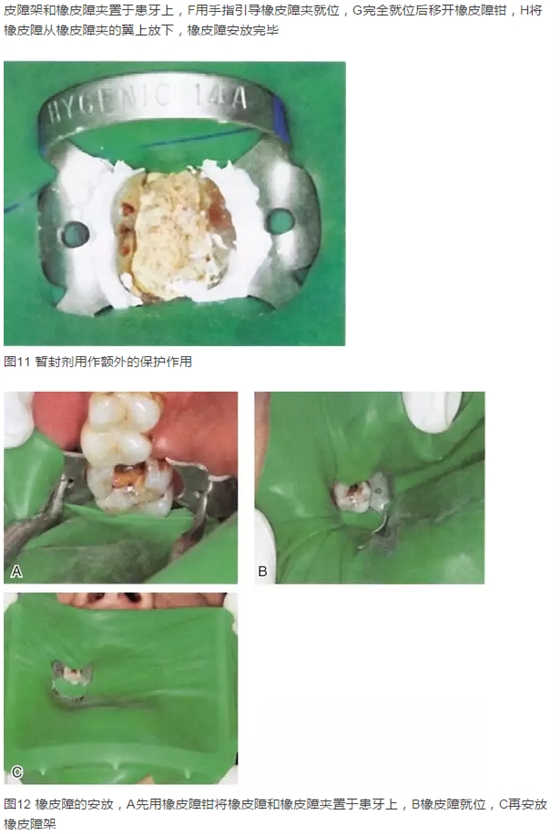 橡皮障隔離之單顆牙隔離方法——陳智教授 橡皮障隔離之單顆牙隔離方法——陳智教授