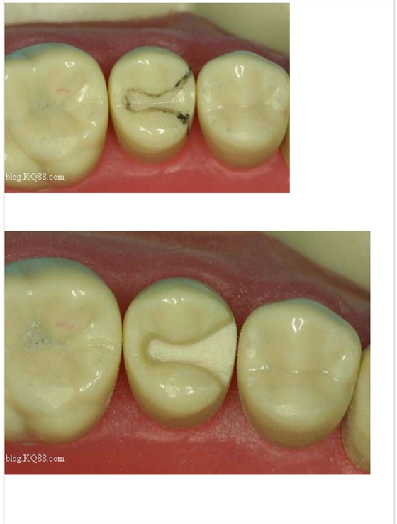 嵌體牙體預備方法 嵌體牙體預備方法