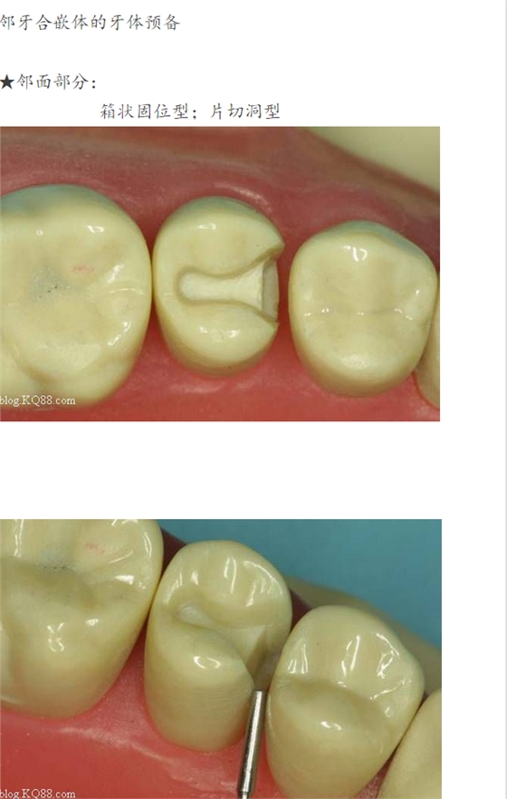 嵌體牙體預備方法 嵌體牙體預備方法