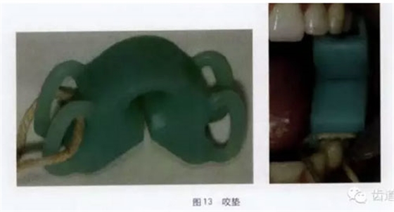 橡皮障的臨床運用大全 橡皮障的臨床運用大全