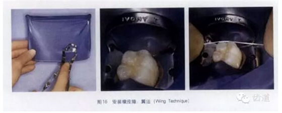 橡皮障的臨床運用大全 橡皮障的臨床運用大全