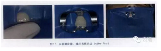 橡皮障的臨床運用大全 橡皮障的臨床運用大全