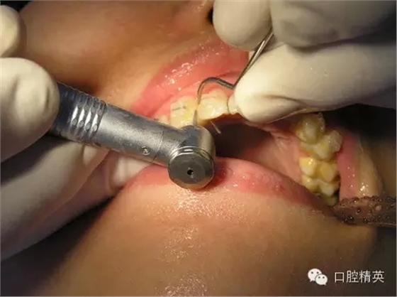 鄰面去釉臨床操作步驟組圖 鄰面去釉臨床操作步驟組圖