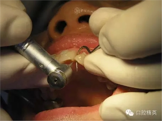 鄰面去釉臨床操作步驟組圖 鄰面去釉臨床操作步驟組圖