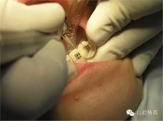 鄰面去釉臨床操作步驟組圖 鄰面去釉臨床操作步驟組圖