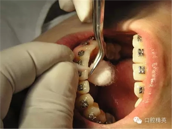 鄰面去釉臨床操作步驟組圖 鄰面去釉臨床操作步驟組圖