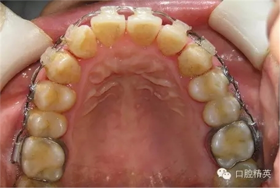 鄰面去釉臨床操作步驟組圖 鄰面去釉臨床操作步驟組圖