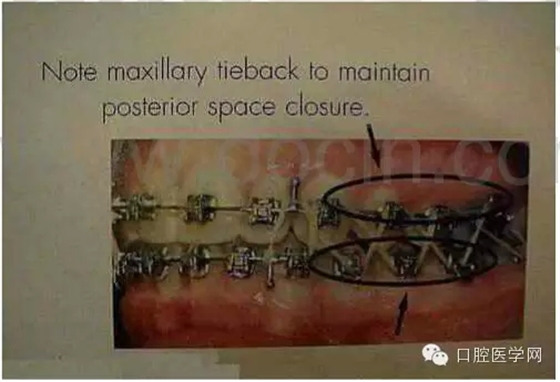 正畸damon system橡皮筋(elastics)掛法示意圖 正畸damon system橡皮筋(elastics)掛法示意圖