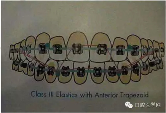 正畸damon system橡皮筋(elastics)掛法示意圖 正畸damon system橡皮筋(elastics)掛法示意圖