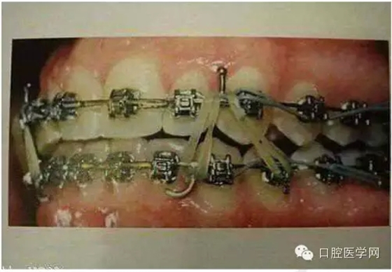 正畸damon system橡皮筋(elastics)掛法示意圖 正畸damon system橡皮筋(elastics)掛法示意圖