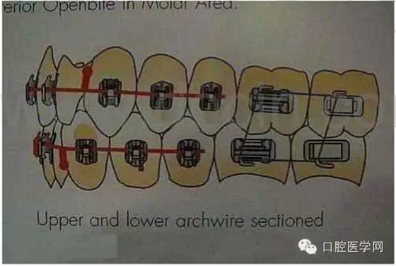 正畸damon system橡皮筋(elastics)掛法示意圖 正畸damon system橡皮筋(elastics)掛法示意圖