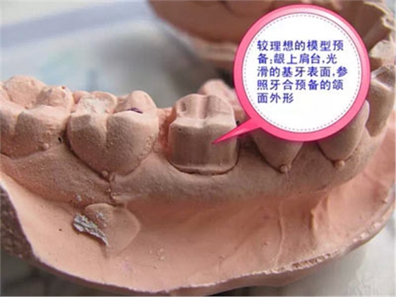 備牙應(yīng)注意的事項+備牙取摸損傷牙齦問題