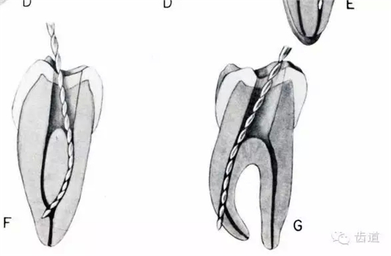 根管治療的并發(fā)癥及處理 根管治療的并發(fā)癥及處理