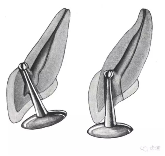 根管治療的并發(fā)癥及處理 根管治療的并發(fā)癥及處理