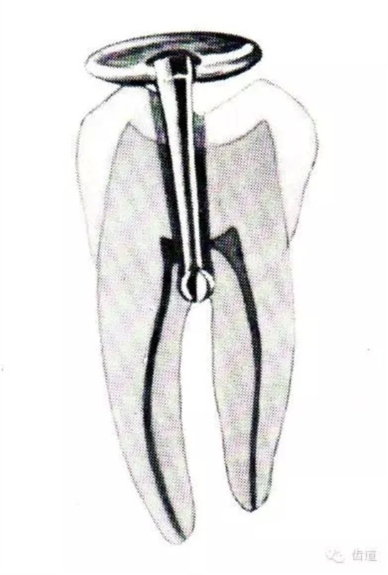 根管治療的并發(fā)癥及處理 根管治療的并發(fā)癥及處理