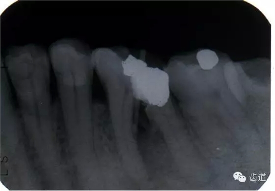 根管治療的并發(fā)癥及處理 根管治療的并發(fā)癥及處理